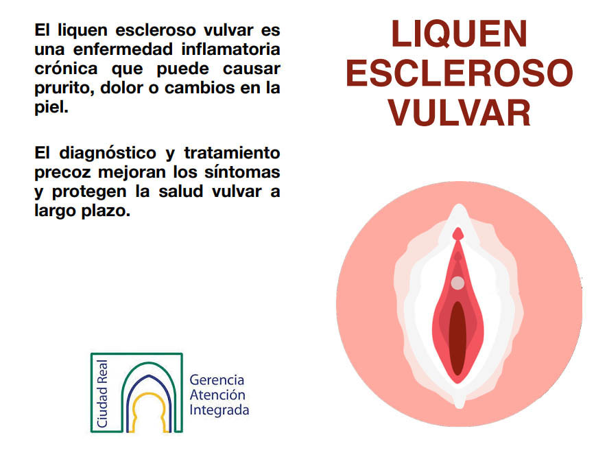 liquen escleroso